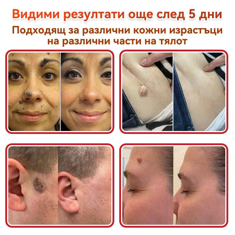 🎁 Остават само 5 опаковки! Сега можете да получите допълнителна ОТСТЪПКА от 50%!🗽✅ GFOUK® Ботаничен пластир с микроигли за премахване на кожни образувания