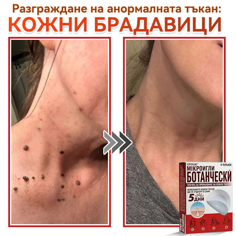 🔥🔥GFOUK® Ботаничен пластир с микроигли за премахване на кожни образувания